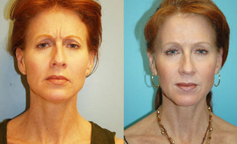 Botox before 322530