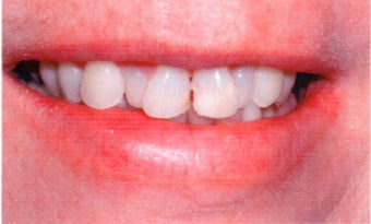 Smile Makeover before 508493