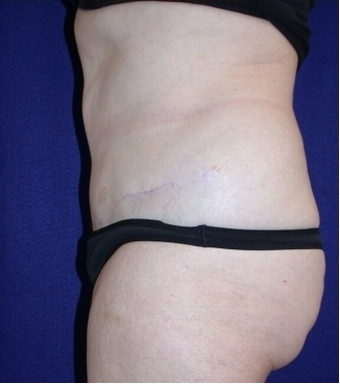 Tummy Tuck (abdominoplasty) 208467