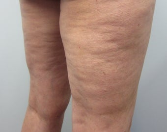 Cellulaze before 583409