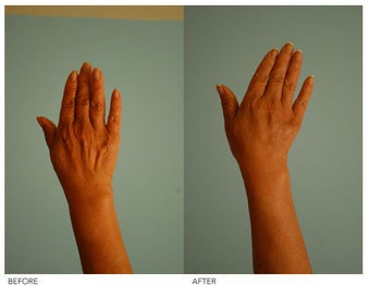 Hand Rejuvenation (with Fat Transfer) before 136421