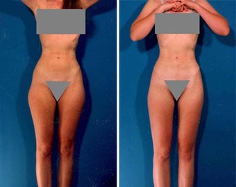 Liposuction before 636106