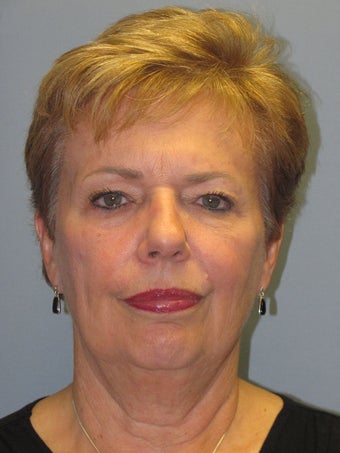 Neck Lift, Platysmaplasty before 634747