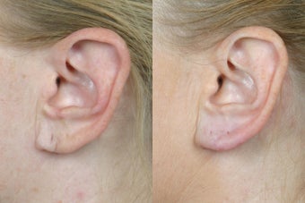 Perlane to Earlobes before 309745