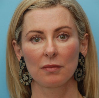Under Eye Dermafiller, Cheek Dermafiller, Restylane after 208582