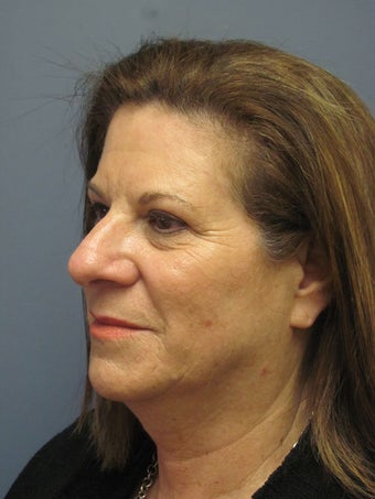 Neck Lift, Platysmalasty 634751