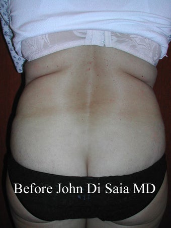 Butt Lift in a prior Tummy Tuck Patient before 100769