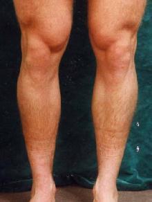 Men's Calf Augmentation 519054