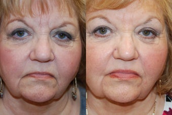Non-Surgical Facial Rejuvenation with Silikon-1000 before 191192