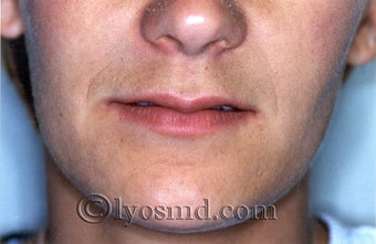 Lip Augmentation before 225377