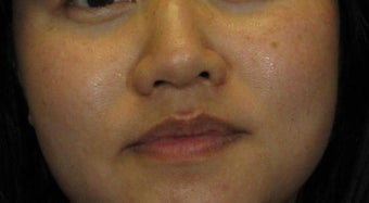 Laser Peels and More Perfect for Ethnic Skin Tones after 628494