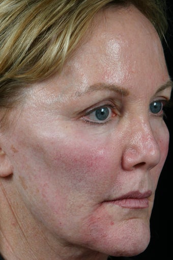 Radiesse to the cheeks 308300
