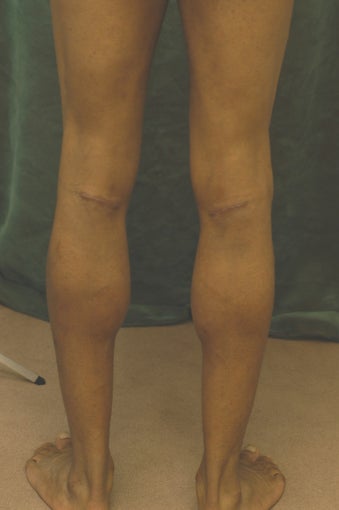 Men's Calf Augmentation after 519061