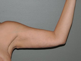 Arm Lift after 530723