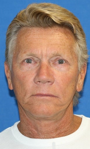 Facelift, Upper Blepharoplasty, Lower Blepharoplasty, & Lower Eyelid Skin Pinch after 514805