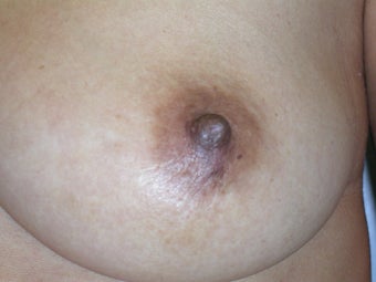 Nipple Reduction after 117551