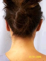 Ear Surgery (Otoplasty) 357657