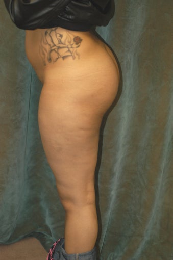 Women's Buttocks Augmentation after 518140