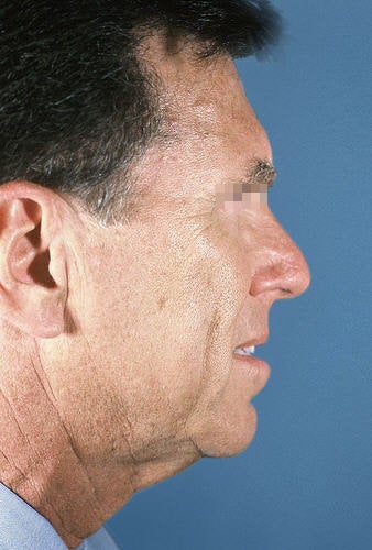 Facelift for Men before 114163