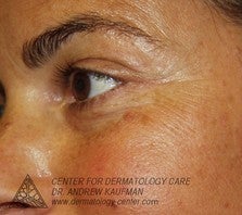 Mohs Surgery of Basal Cell Carcinoma and Recontruction after 315051