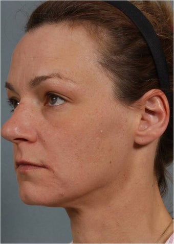 41 Year Old Female Treated for sun damage, wrinkles, and acne scars 645384