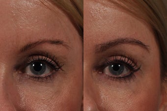 Eyebrow Hair Transplant before 575284