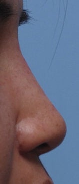 Non Surgical Rhinoplasty after 308293