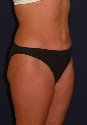 Tummy Tuck / Abdominoplasty after 55020