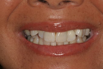Invisalign before 206798