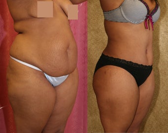 tummy tuck before 304683