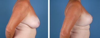 Breast Lift after 355777