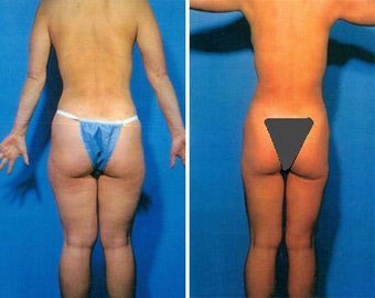 Liposuction before 636098