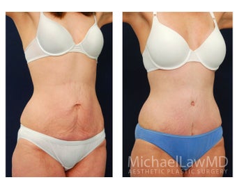 Abdominoplasty - Tummy Tuck after 396105