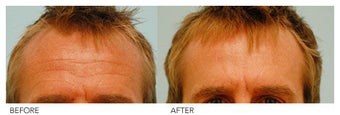 Botox before 138519