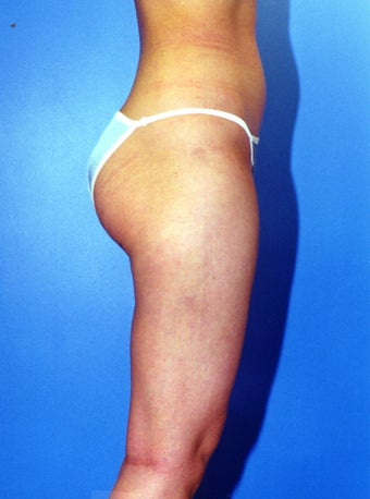 liposuction of thighs for women after 583572