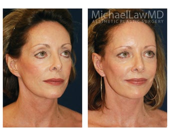 Facial Rejuvenation 393316