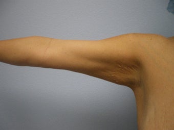 Arm Lift before 155759