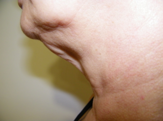 TriPollar before 525490