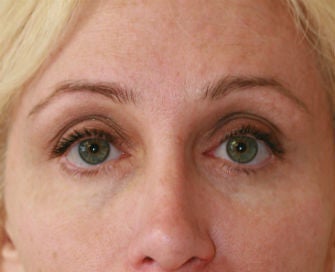 Eyelid rejuvenation before 378928