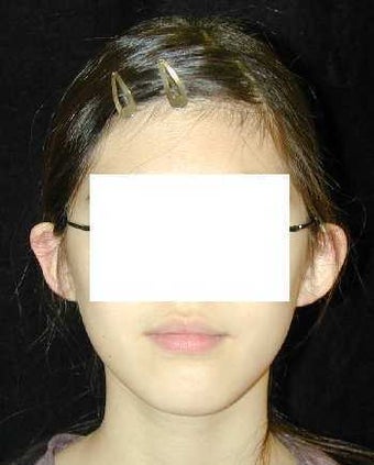 Otoplasty - Ear Surgery before 215189