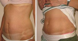 C-section scar revision with excision and SlimLipo before 104387