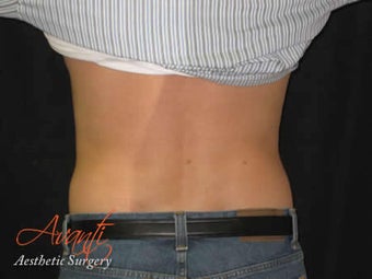 Vaser Lipo - Flanks after 376423