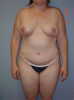 Mommy Makeover after 264612