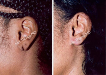 Earlobe Surgery before 243333