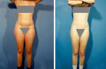 Liposuction before 636235