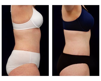 Liposuction 397021