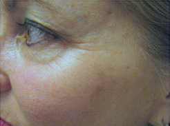 Fractional CO2 laser 459268