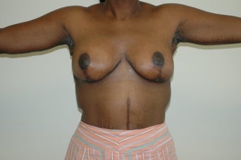 Arm Lift (brachioplasty) after 333738