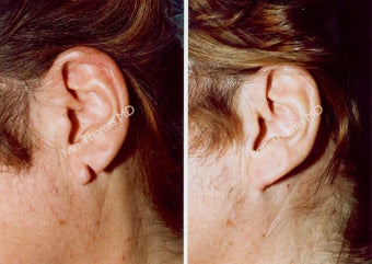 Earlobe Surgery before 243326