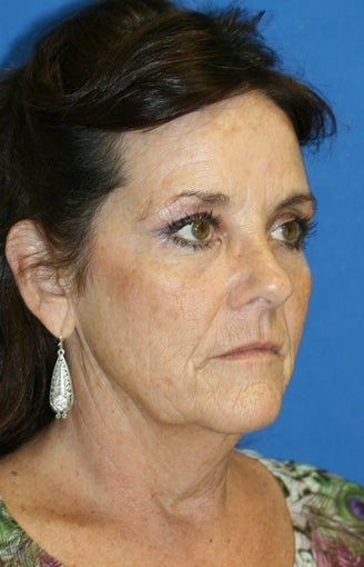 1 month pot-op: Facelift, Necklift, Neck Liposuction, Fat Transfer, and Browlift before 424191
